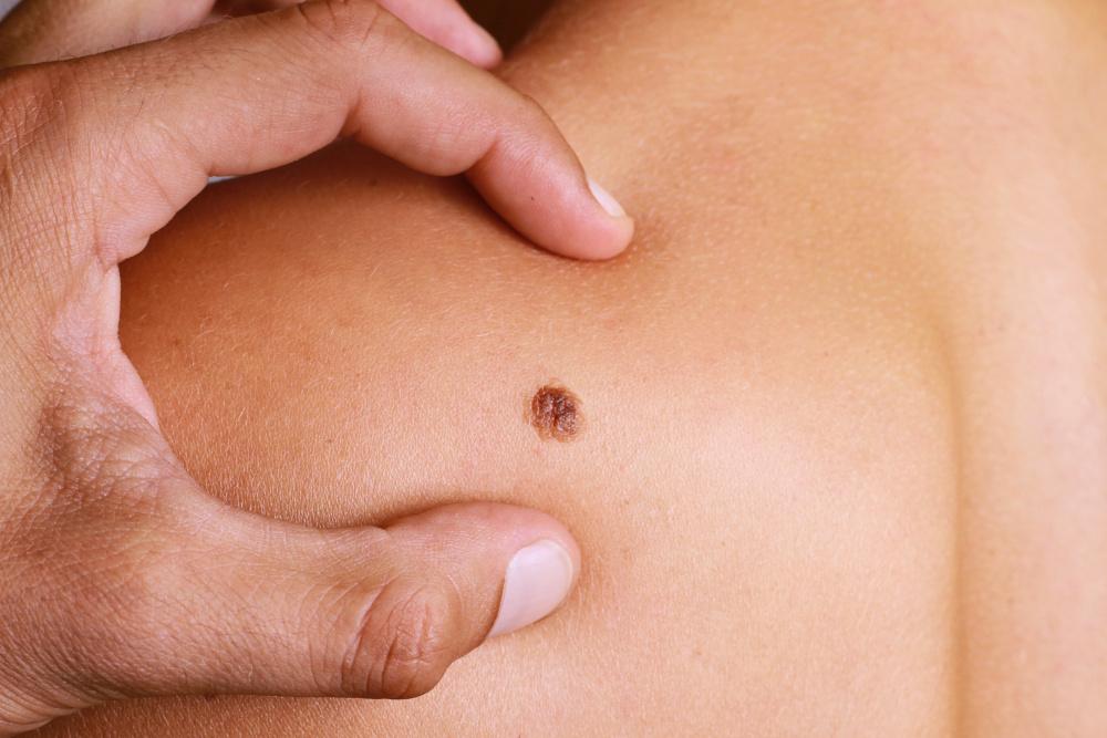 Early Detection of Skin Cancer Through Noncontact Infrared Thermography